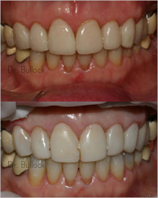 Before and After