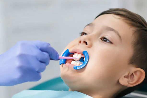 dental sealant aplied to front of teeth