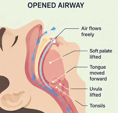 open airway sleep apnea diagram